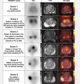 PET/MRI可准确对前列腺癌患者进行分类有可能避免不必要的活检