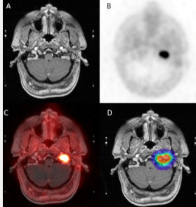 与黄金标准MRI相比PET/CT对头部和颈部副神经节瘤的病变检测效果更佳