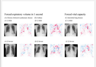 创新高精度的AI模型仅通过胸部X光即可评估肺功能